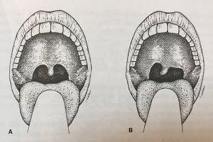 CN IX: GLOSSOPHARYNGEAL CN X: VAGUS Use the tongue blade to control the tongue and ask the patient to say Ah Observe the elevation of the soft palate and uvula Expect