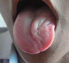 CN XII HYPOGLOSSAL Have the patient stick the tongue