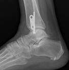 heel pad repair and primary closure