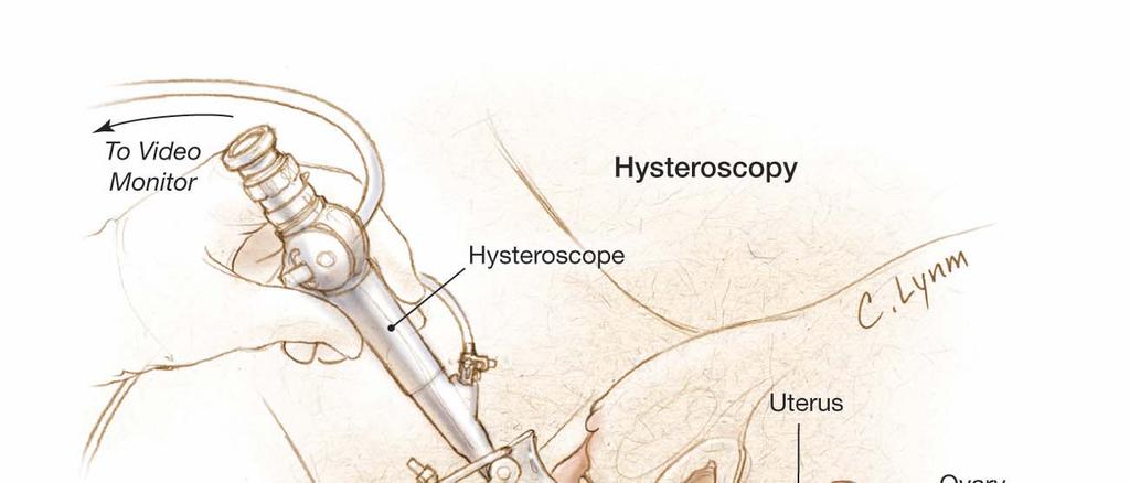 Hysteroscopes Diagnostic Flexible 2.