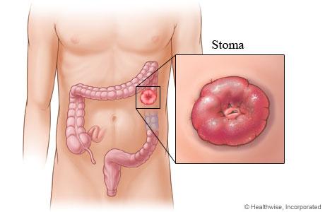 What is a colostomy?