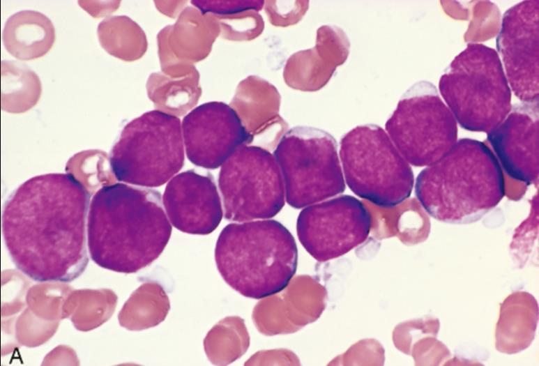 -Lymphoid neoplasms are: 1. Precursor B and T cell lymphoblastic lymphoma/leukemia, commonly called Acute Lymphoblastic Leukemia (ALL). 2. Chronic Lymphocytic Leukemia/ Small Lymphocytic Lymphoma. 3.