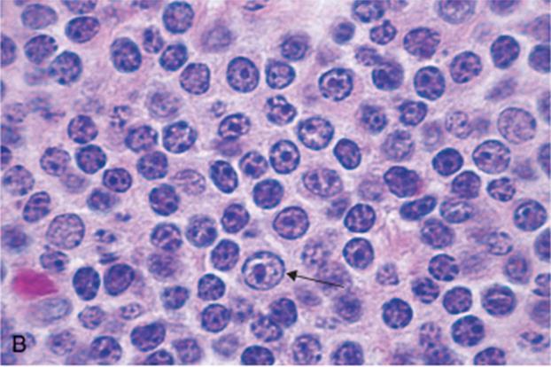 On the other hand, if the cells are large we call it diffuse large B cell lymphoma Higher magnification As you see, all lymphocytes look mature, sometimes you may see some abnormal pro-lymphocytes.