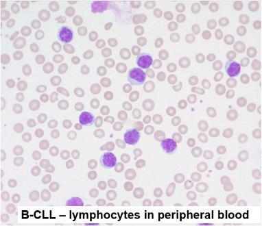 In lymphoma, bone marrow is invariably involved: less than 30% involvement If there s more than 30% bone marrow involvement Leukemia Typically, the patients are elderly with generalized