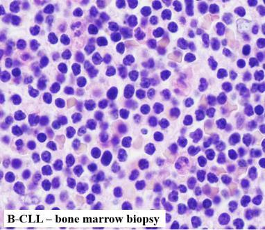 - Neoplasm of mature lymphocytes - Accumulation of mature B-lymphocytes in BM or PB - Epidemiology: Most common leukemia in West 30% of all leukemia Older adults (median age 70 y) CLL Clinical