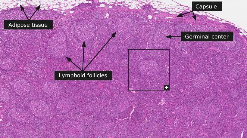 ? On what cell can you find CD10? On B lymphocyte within lymphoid follicles (germinal center). So as we said follicular lymphoma arising from the lymphoid follicles should express CD10.
