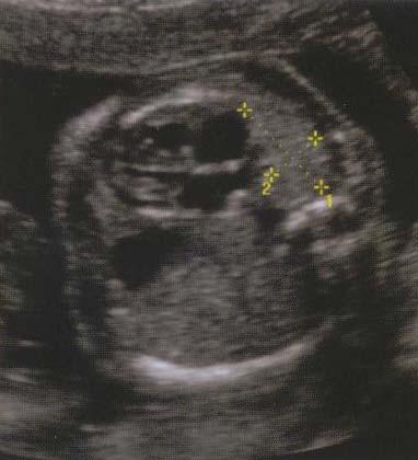 Prenatal ultrasound Diagnosis Polyhydramios (80%)