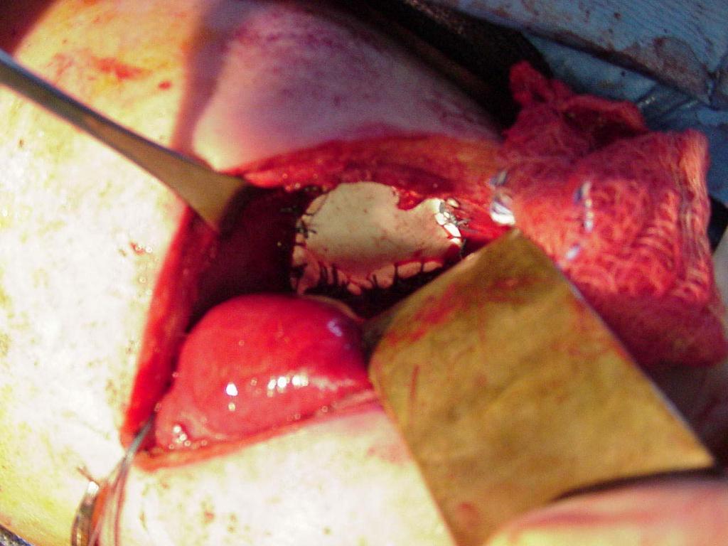 Open Surgery Subcostal Incision pull abdominal organs back