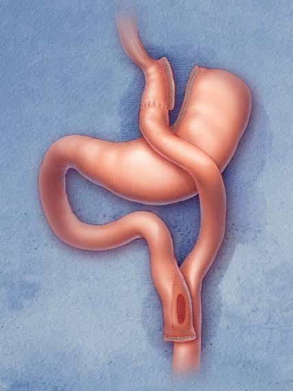 Bariatric Surgery Gastric Bypass 1. A small pouch is separated from the top of the stomach and sealed. 2. Staples are used to create the seals. 3.
