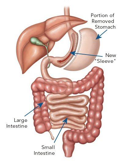 Sleeve Gastrectomy Generates weight loss by restricting the amount of food that can be eaten. Stomach is stapled and divided vertically, which removes 80-85% of the stomach.