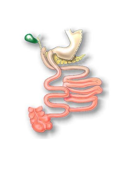Evolution of Sleeve Gastrectomy Sleeve is first part of Duodenal Switch operation In high risk and super-obese