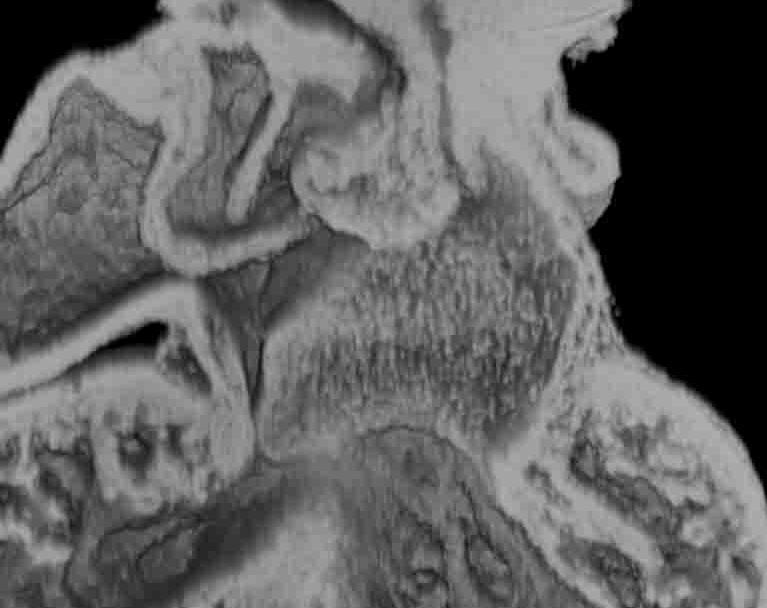 Vestibular spine Pulmonary