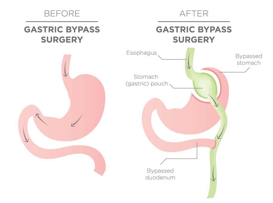 4 BARIATRIC SURGERY PROCEDURES Bariatric surgical procedures cause weight loss by restricting the amount of food the stomach can hold, causing malabsorption of nutrients, or by a combination of both