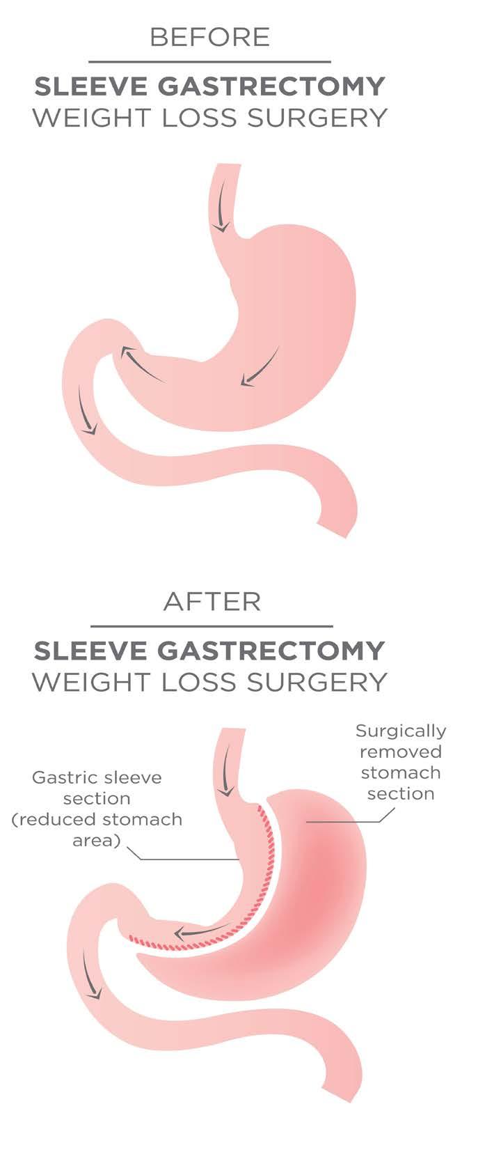 6 SLEEVE GASTRECTOMY The Laparoscopic Sleeve Gastrectomy often called the sleeve is performed by removing approximately 80 percent of the stomach.