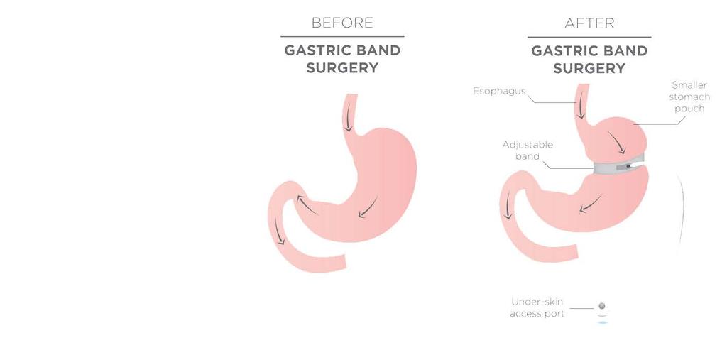 7 ADJUSTABLE GASTRIC BAND The Adjustable Gastric Band often called the band involves an inflatable band that is placed around the upper portion of the stomach, creating a small stomach pouch above