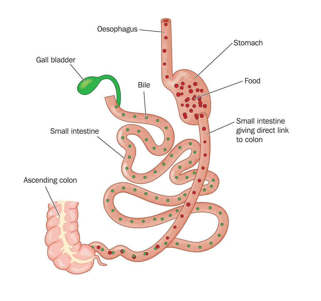 8 BILIOPANCREATIC DIVERSION WITH DUODENAL SWITCH (BPD/DS) GASTRIC BYPASS The Biliopancreatic Diversion with Duodenal Switch abbreviated as BPD/DS is a procedure with two components.