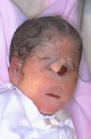 This baby with trisomy 13 has cyclopia (single eye) with a proboscis (the