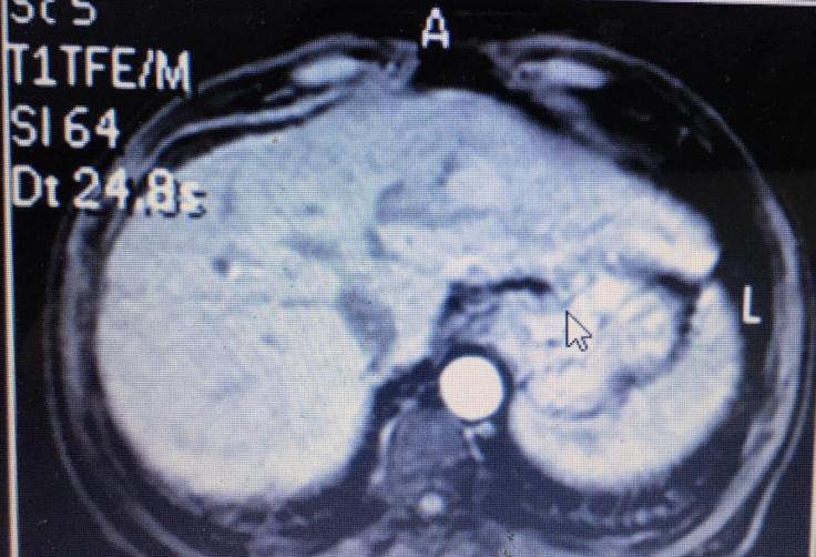 Role of MRI in Assessment of Hepatocellular Carcinoma Arterial phase Delayed phase Diagnosis: residual tumor tissue at segment VI.