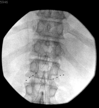 52 yr old male patient with significant bilateral post-hernia repair