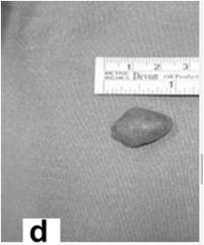 Case 1 Personal kidney stones Cystine stones Prescribed Tiopronin to control cysteine precipitation and excretion Was this Prerenal, Renal, or