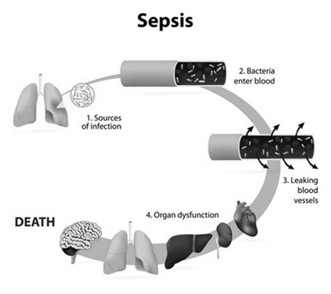 Sepsis double whammy Vasodilation Increased permeability Decreased effective volume Sepsis Most common cause of acute kidney injury in the ICU Hypoperfusion Was this Prerenal, Renal, or Postrenal?