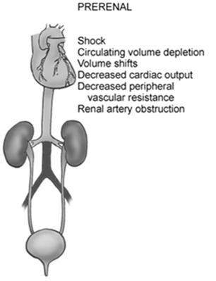 !! Prerenal AKI Renal (Intrarenal) AKI Results from hypoperfusion of kidney Intravascular volume