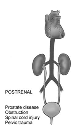Postrenal AKI Results from damage or obstruction past the kidneys Stones in ureter, bladder Tumors