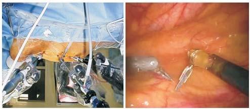 Robotic-Assisted Coronary Artery Bypass MATERIALS AND METHODS Ten patients underwent robotically assisted endoscopic CABG of the left internal thoracic artery (LITA) to the left anterior descending