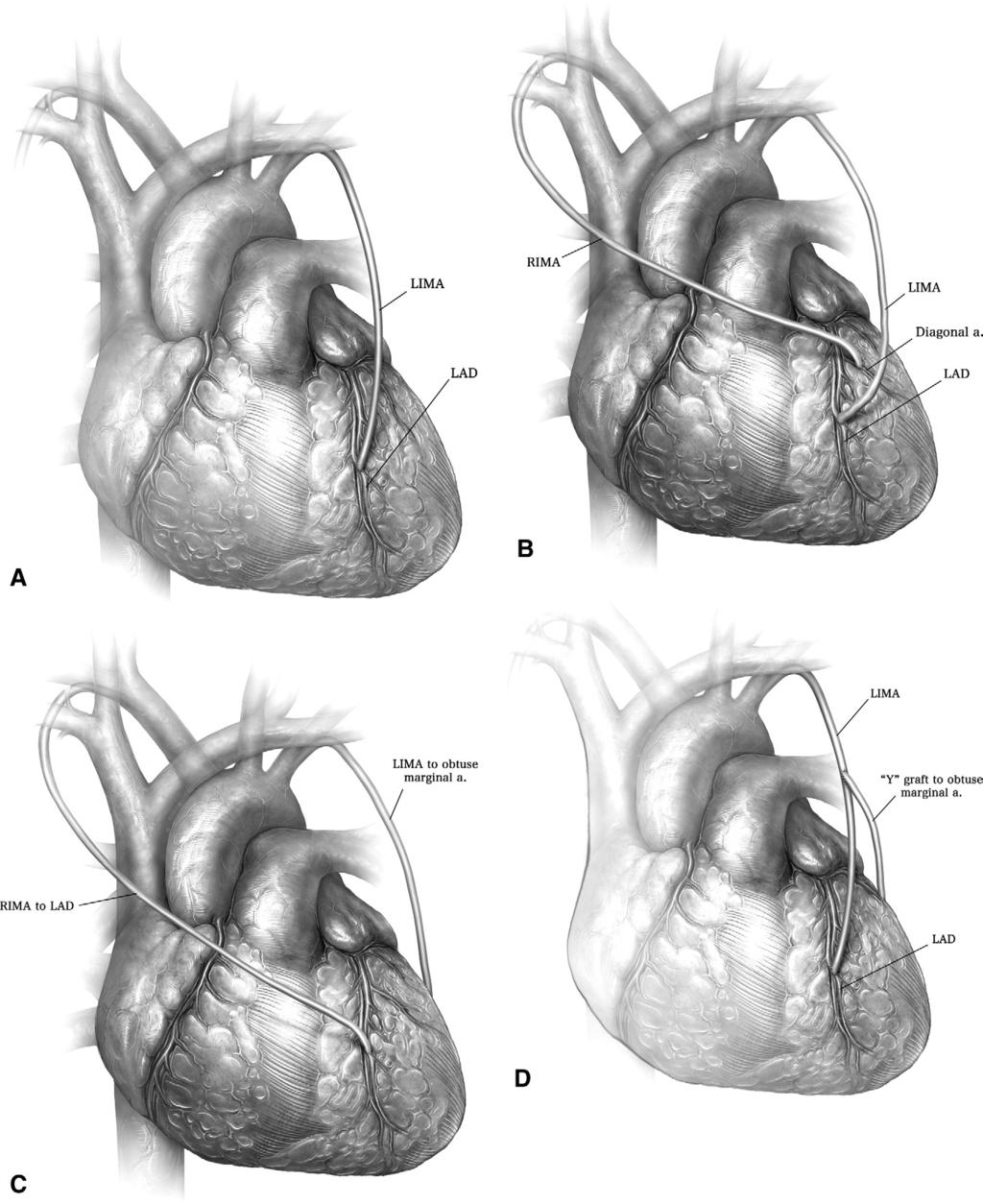Robotic coronary artery bypass grafting 203 Figure 9 (A) LIMA to LAD is the most common type of bypass grafting in both RCAB and TECAB.