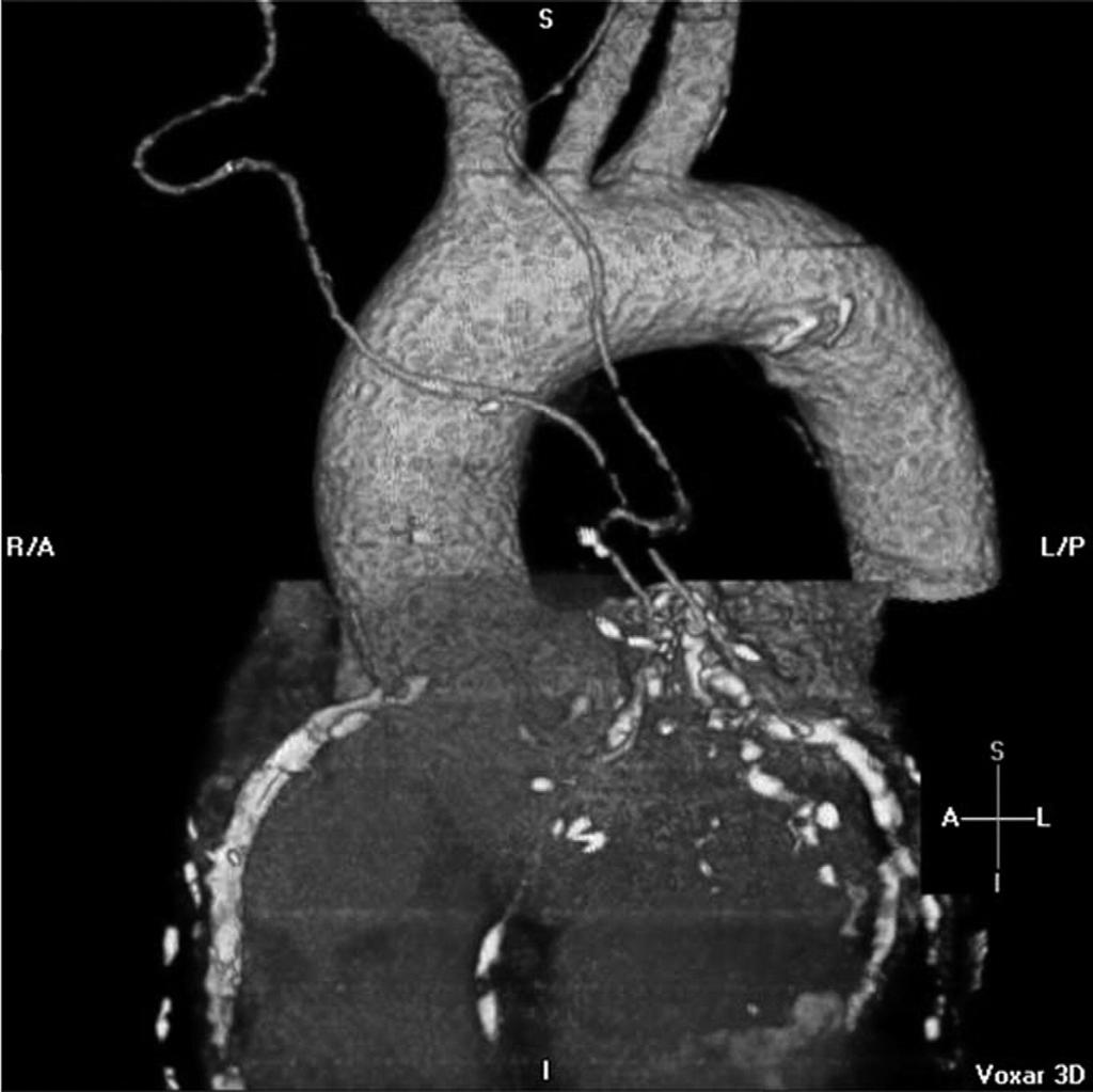204 K.K. Liao Figure 10 Postoperative chest computed tomography angiogram with 3D reconstruction shows the course of in situ LIMA to LAD and RIMA to Ramus intermedius artery. Both grafts are patent.