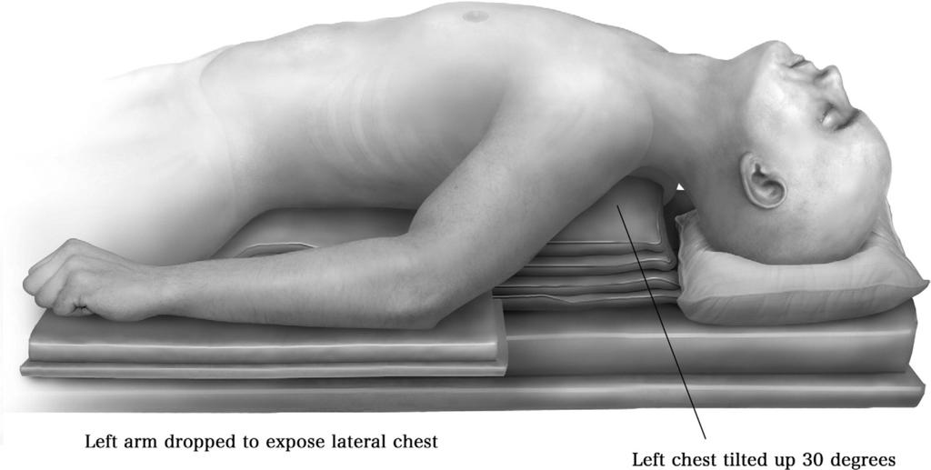 Robotic coronary artery bypass grafting 195 Figure 1 The patient is positioned supine and prepped and draped from the neck to the mid thigh. The left chest is tilted up 30.