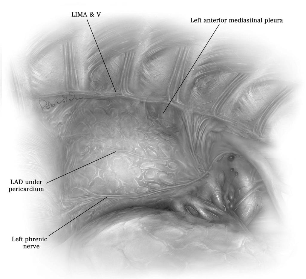Robotic coronary artery bypass grafting 197 Figure 3 Endoscopic view from the left pleural cavity shows the relationship among LIMA, anterior mediastinal pleura, ribs, left phrenic nerve, and LAD