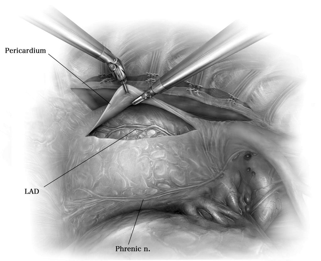 Robotic coronary artery bypass grafting 199 Figure 5 The pericardium is opened longitudinally. The target vessels (LAD and diagonal) are visualized.