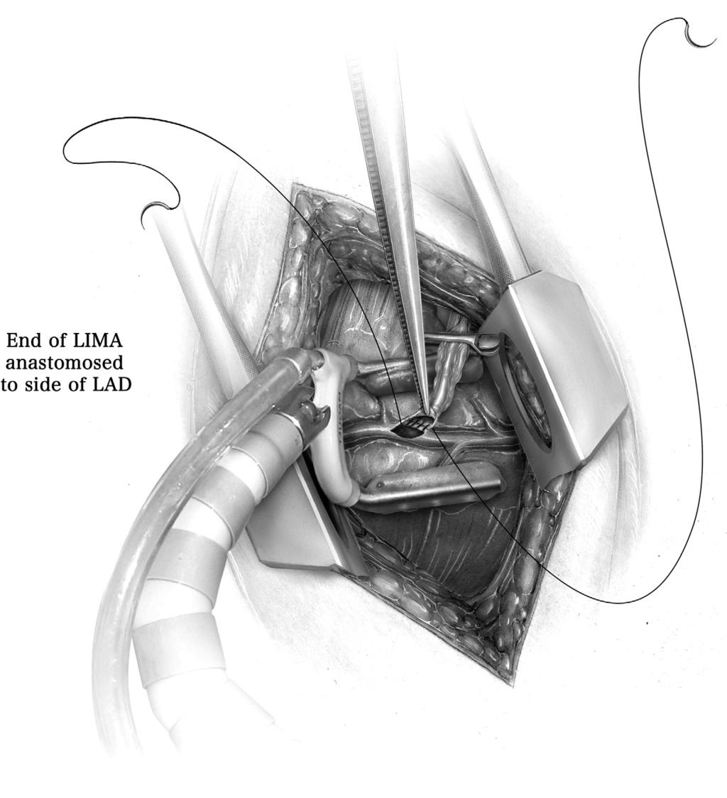 200 K.K. Liao Figure 6 A 5- to 6-cm left mini-thoracotomy is made over the target segment of LAD. A small retractor is placed to gently open the rib space.