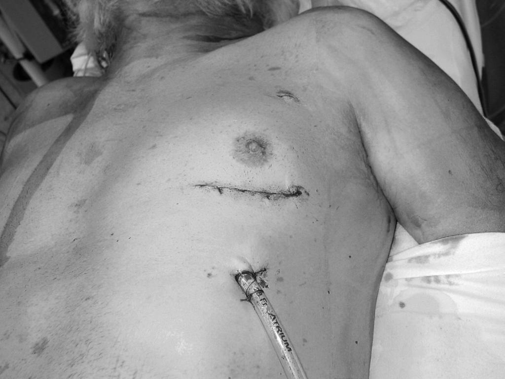 Robotic coronary artery bypass grafting 201 Figure 7 The typical skin incision and chest tube placement after a RCAB with either LIMA to LAD or LIMA and RIMA to LAD and other left coronary bypass