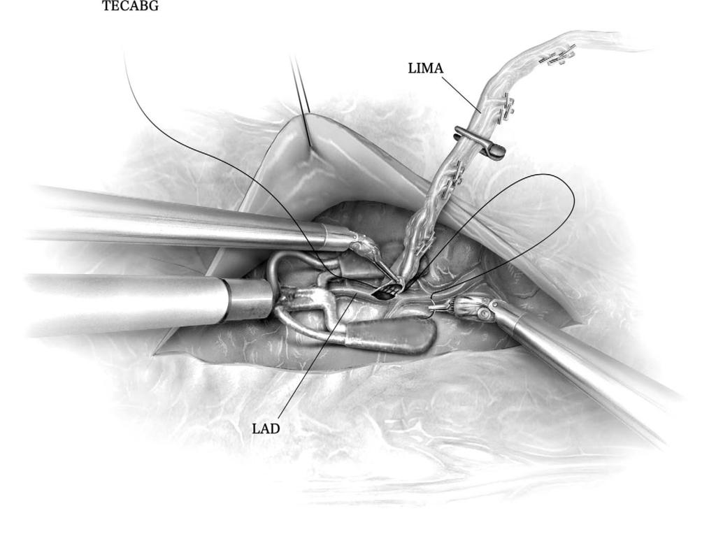 202 K.K. Liao Figure 8 TECAB with robotic anastomosis of LIMA to LAD with a 7-0 Prolene suture.