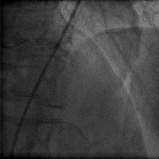dependant) Prev stroke PVD Renal dysfunction (Scr 200) Asc aortic