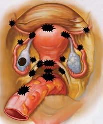 LOCATIONS Ovary/Fallopian tube Uterus Uterine ligaments Cul de sac Pelvic