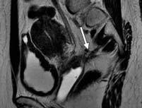 significant pathologies present (ovary cyst, fibroid) MRI Undistended
