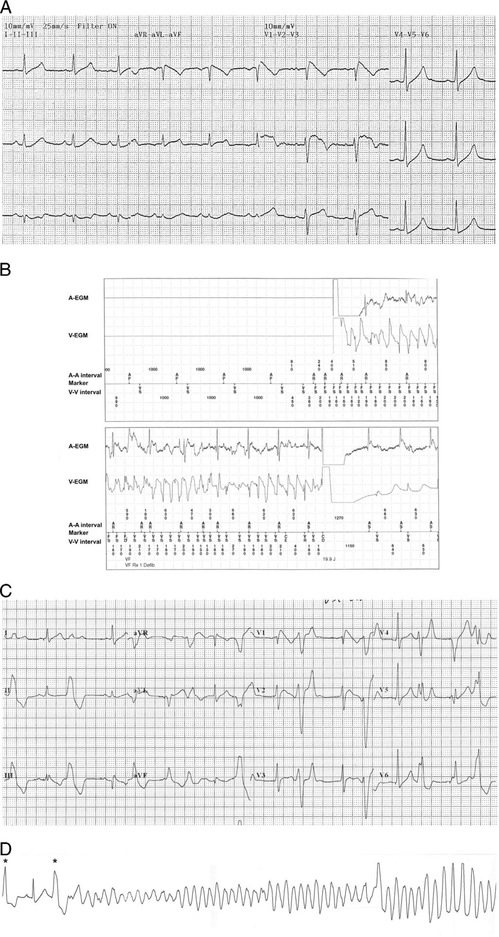 488 Heart Rhythm Case Reports, Vol 2, No 6, November 2016 Figure 1 A: Standard 12-lead electrocardiogram (ECG) showing partial right bundle branch block with a coved ST-segment elevation and negative