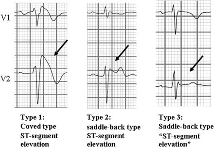 THE BRUGADA SYNDROME Type 1 only is specific of the Brugada s syndrome THE BRUGADA