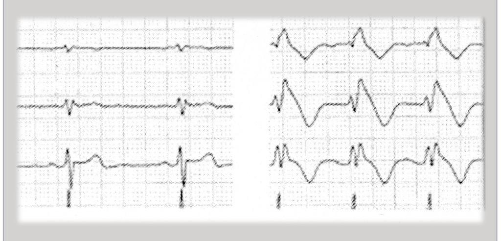 THE BRUGADA SYNDROME Onset of a Ventricular Fibrillation in a