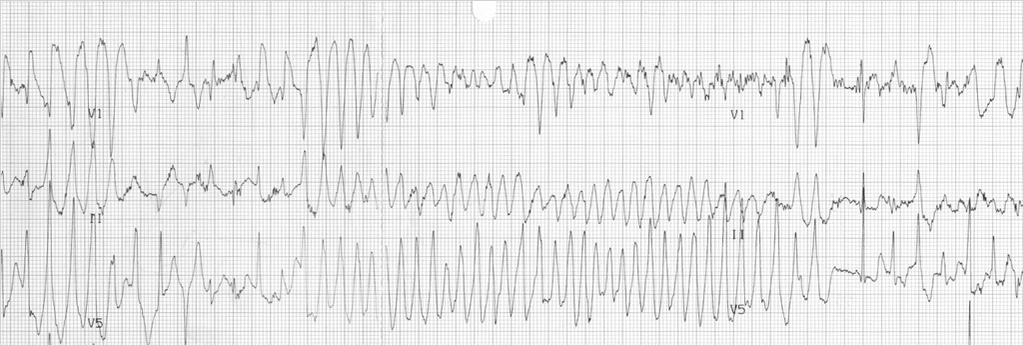 CATECHOLAMINE INDUCED POLYMORPHIC VENTRICULAR TACHYCARDIA (CPVT) CATECHOLAMINERGIC POLYMORPHIC VENTRICULAR TACHYCARDIA (CPVT) BaselineECGisquiteoftenNORMAL Children withahistoryofsyncopeorsudden