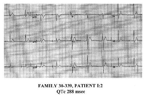 SHORT QT SYNDROME DEFINITION QTc<320ms Family History of S.D. Palpitations, syncope at rest or during efforts.
