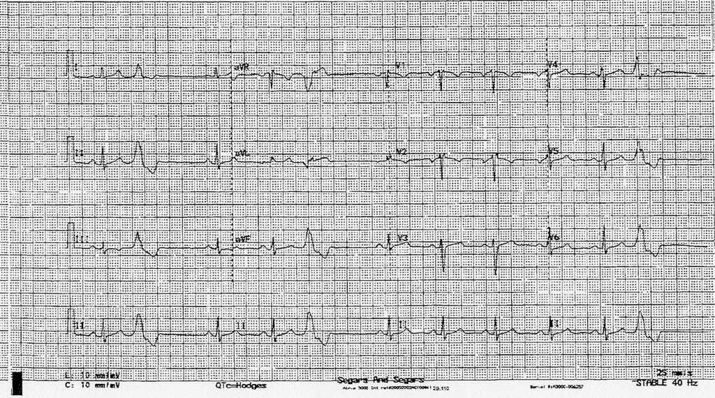 26/08/2013 CASE STUDY N 1 36 year old Caucasian female. Personal history of recurrent syncope. Family history of Brugada Σd (mother) and sudden death (but no genetic lesion identified).