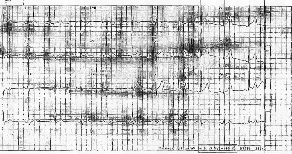 26/08/2013 CASE STUDY N 3 CASE STUDY N 3 43 years old male. Brugada Σd with an AICD implanted 5 years ago. 400.000$ / 20 yrs (Death / PTD). Standard ECG : Type 2 BrS.