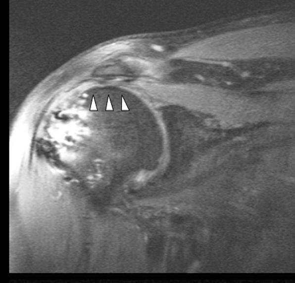 MRI Limitations Post surgical accuracy Distinguishing scar from