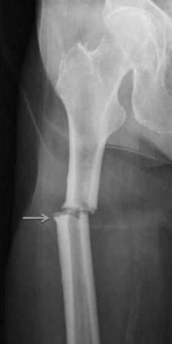Atypical Femoral Fractures (AFF) Thousands of reports in long-term bisphosphonate users (and others) Transverse not spiral, cortical thickening, minimal trauma Often bilateral, prodromal pain, abn.