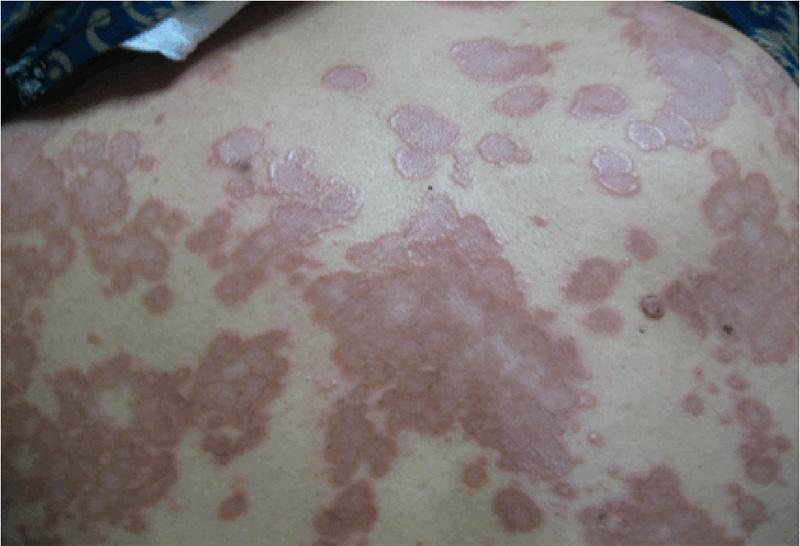 Figure 1. A female patient in systemic sarcoidosis group developed diffused annular cutaneous lesions on the back. Table 3.
