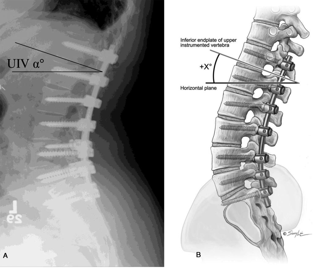 vertebra, rigid implant systems, preoperative hyperkyphotic thoracic alignment, post-operative sagittal imbalance, sagittal imbalance associated with hip and knee degeneration, and acute corrections
